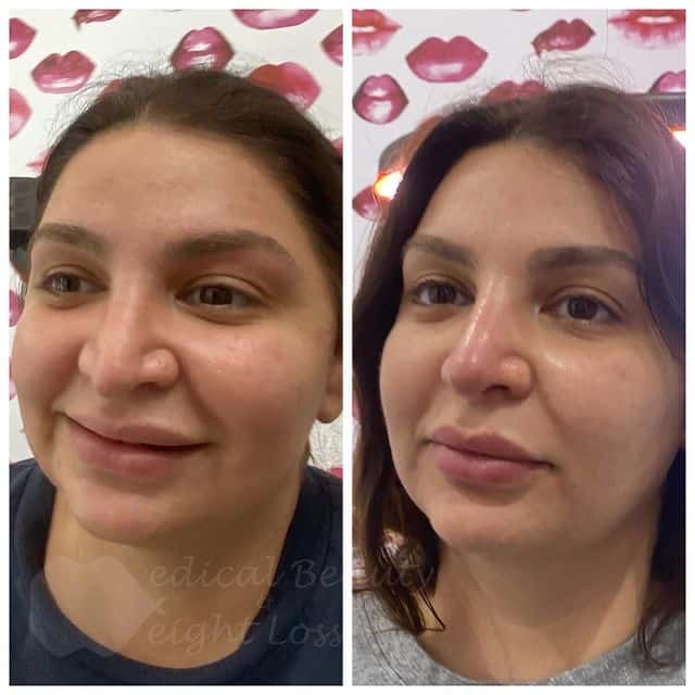 Before and After Face Care Treatment | Medical Beauty and Weight Loss | Chino, CA