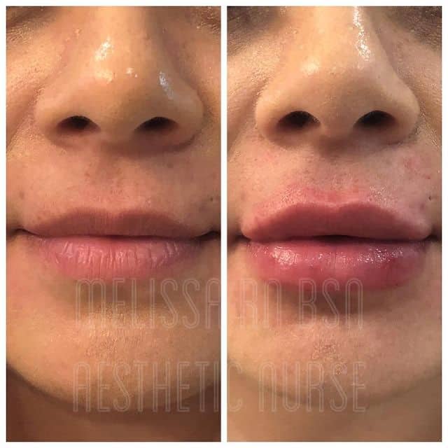 Before and After Lip Fillers Treatment | Medical Beauty and Weight Loss | Chino, CA