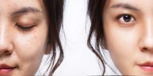 How Neurotoxin Can Reduce The Appearance Of Wrinkles | Medical Beauty and Weight Loss | Chino, CA