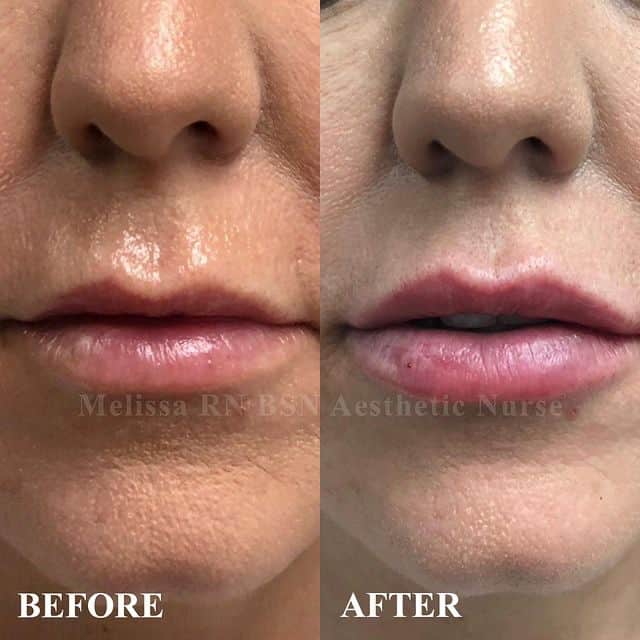 Before and After Fillers Treatment | Medical Beauty and Weight Loss | Chino, CA