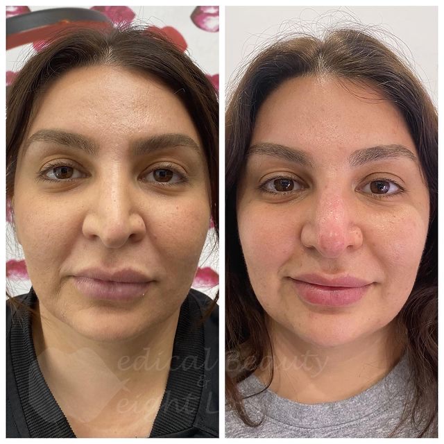 Before and After Result of Facial Treatment | Medical Beauty and Weight Loss | Chino, CA